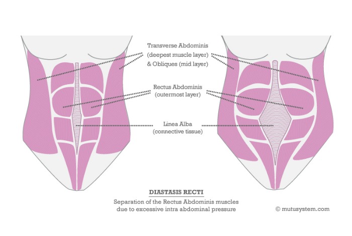 Diastasis-Recti-V3